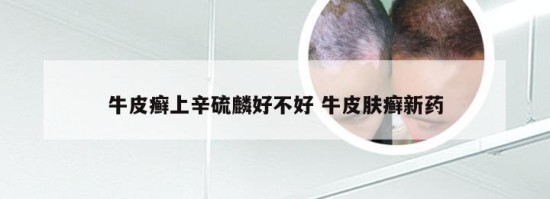 牛皮癬上辛硫麟好不好 牛皮膚癬新藥